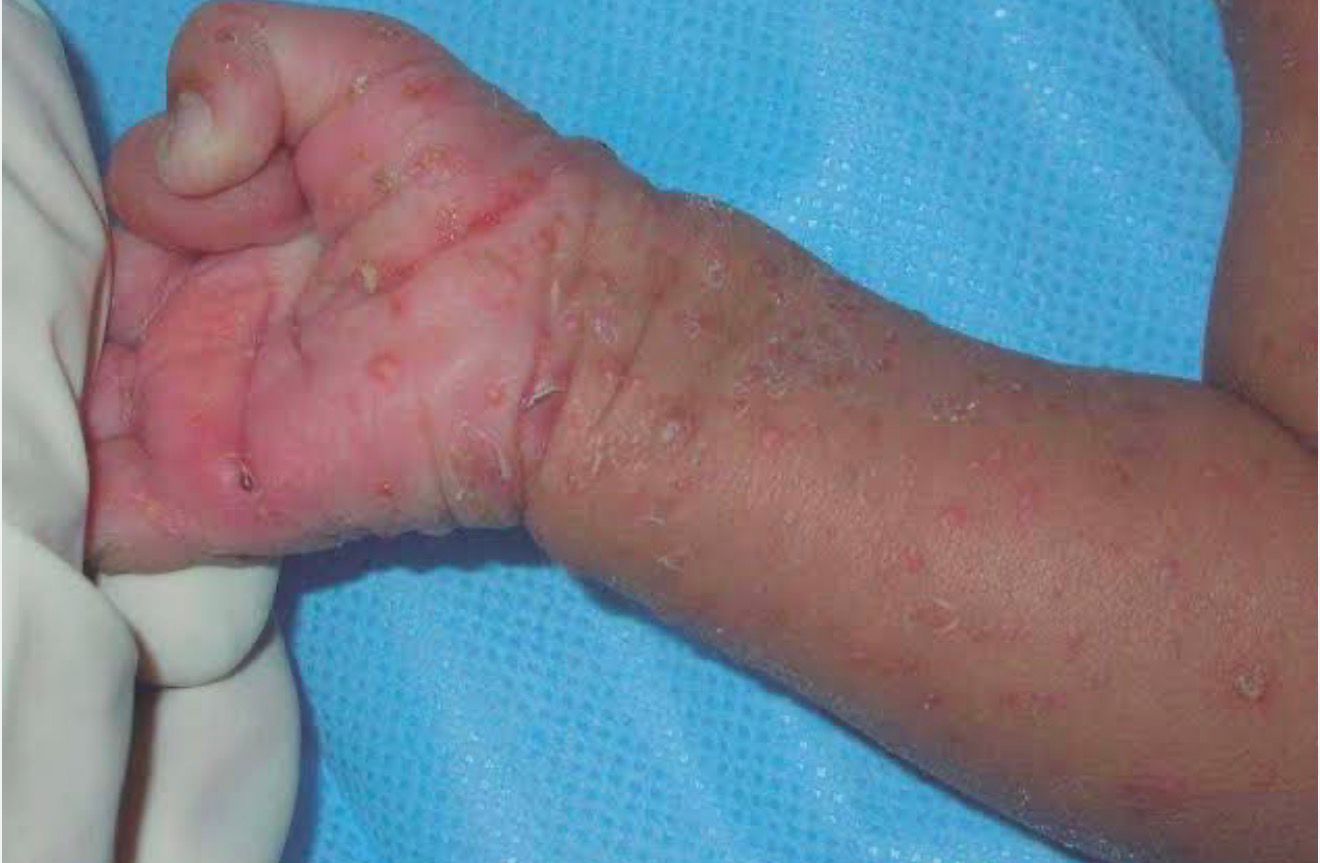 CREMA PARA ESCABIOSIS POTE X 50GR