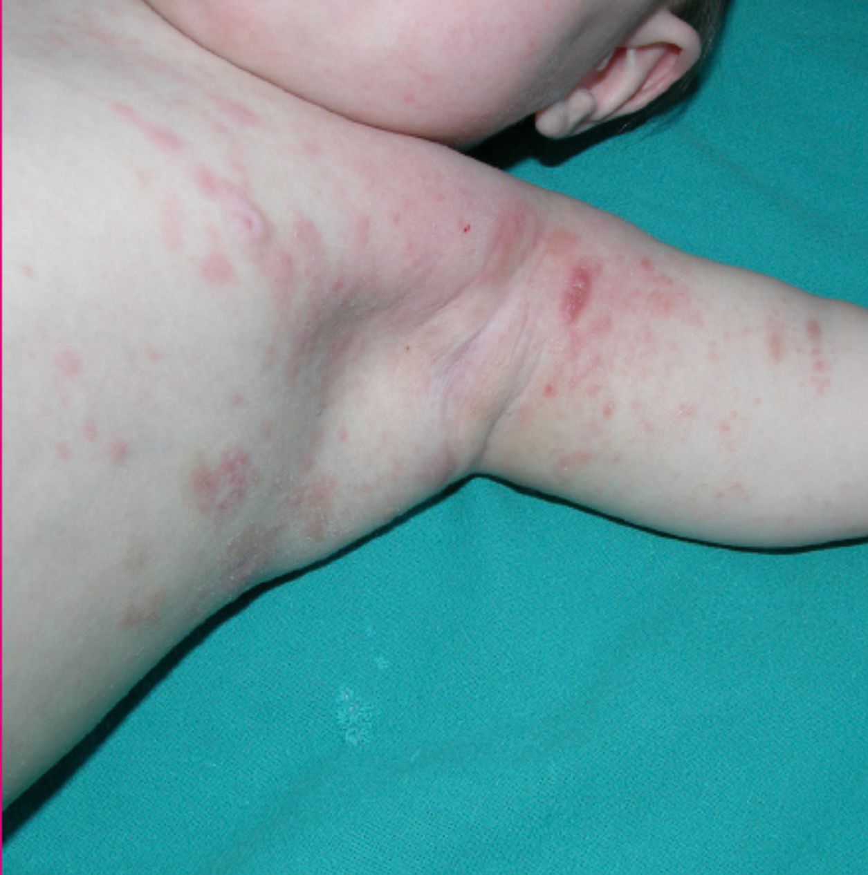 CREMA PARA ESCABIOSIS POTE X 50GR